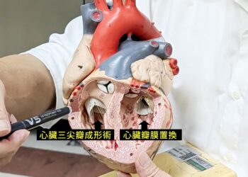 東港安泰醫院複合性心臟手術 助86歲阿嬤成功延壽