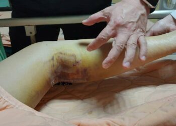 影音/蒙古少婦因久坐、喝水少左下肢脹痛　六千公里台灣求診恢復情況良好