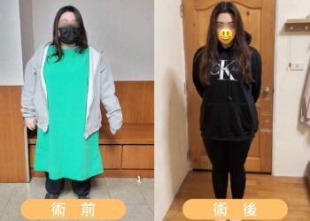 藥物、飲控無助減重 112公斤女胃繞道手術逆轉肥胖