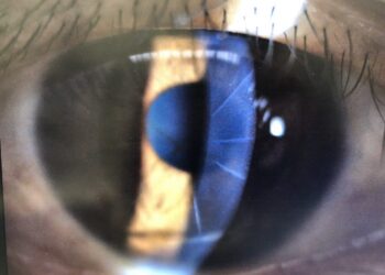 舊式近視矯正術後遺症頻發?信賴眼科有解　引進義大利新儀器「角膜斷層掃瞄儀」