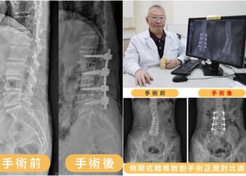 影音∕側開式腰椎微創手術 治癒八旬嬤背痛與駝背